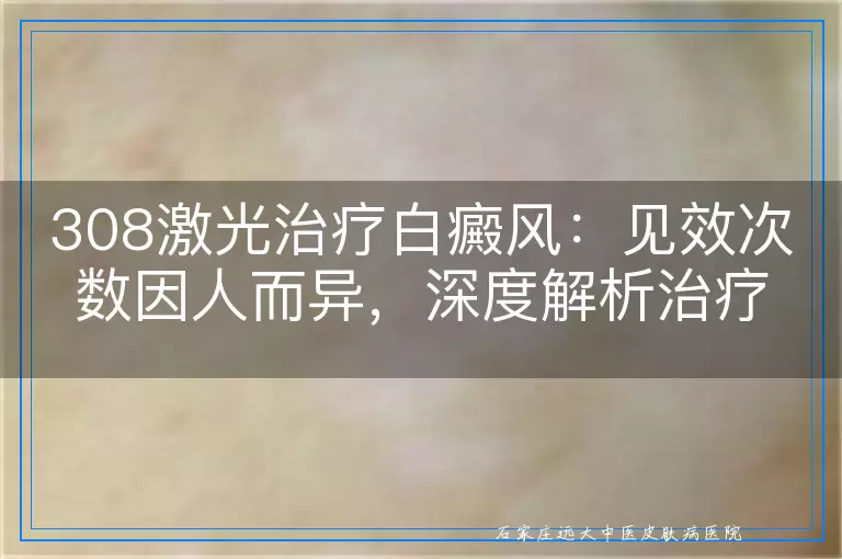 308激光治疗白癜风：见效次数因人而异，深度解析治疗过程与效果