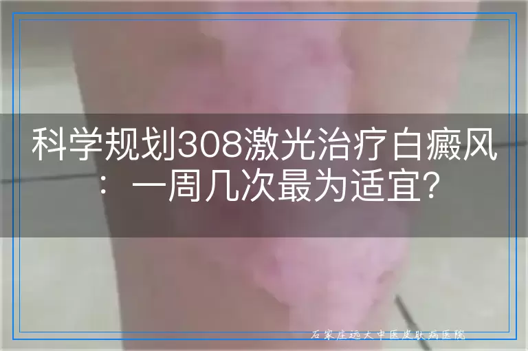科学规划308激光治疗白癜风：一周几次最为适宜？