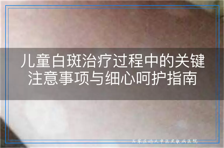 儿童白斑治疗过程中的关键注意事项与细心呵护指南