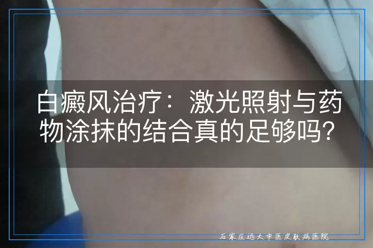 白癜风治疗：激光照射与药物涂抹的结合真的足够吗？