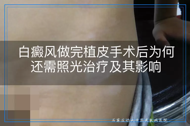 白癜风做完植皮手术后为何还需照光治疗及其影响