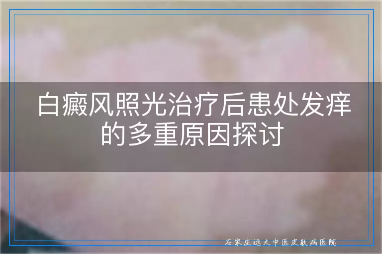 白癜风照光治疗后患处发痒的多重原因探讨