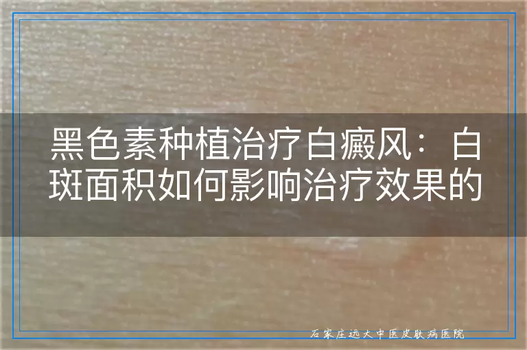 黑色素种植治疗白癜风：白斑面积如何影响治疗效果的多维度考量