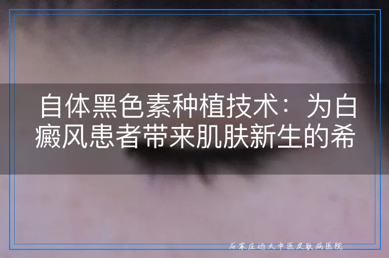 自体黑色素种植技术：为白癜风患者带来肌肤新生的希望之光