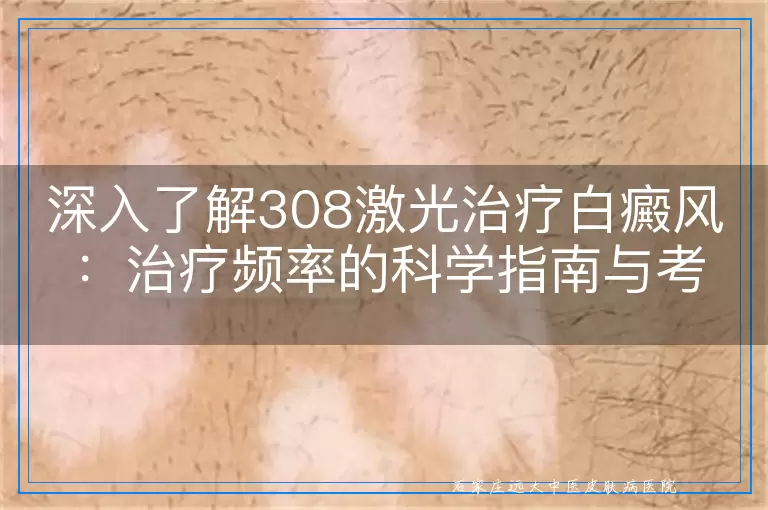 深入了解308激光治疗白癜风：治疗频率的科学指南与考量因素