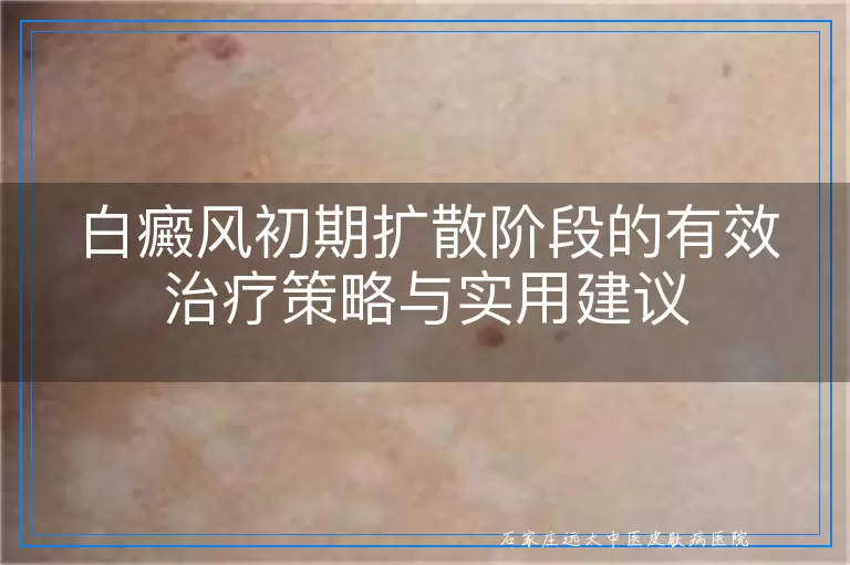 白癜风初期扩散阶段的有效治疗策略与实用建议