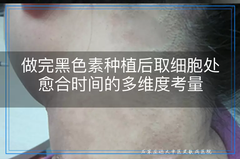 做完黑色素种植后取细胞处愈合时间的多维度考量