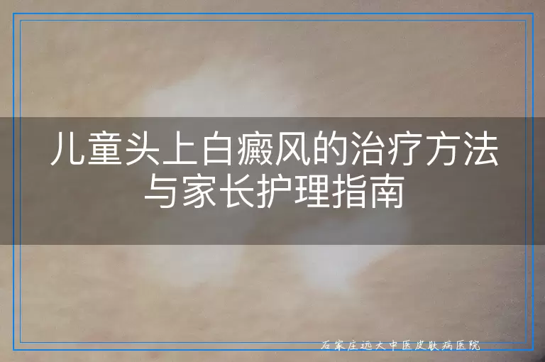 儿童头上白癜风的治疗方法与家长护理指南