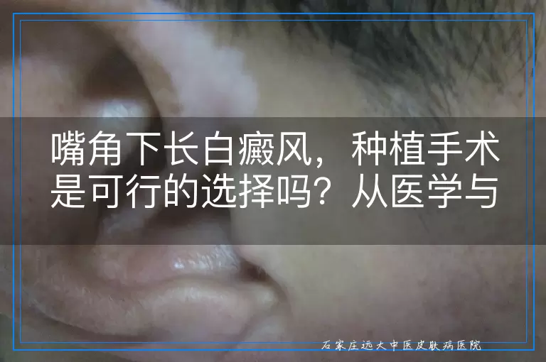 嘴角下长白癜风，种植手术是可行的选择吗？从医学与美学角度深入探讨