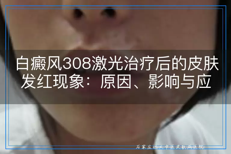 白癜风308激光治疗后的皮肤发红现象：原因、影响与应对策略