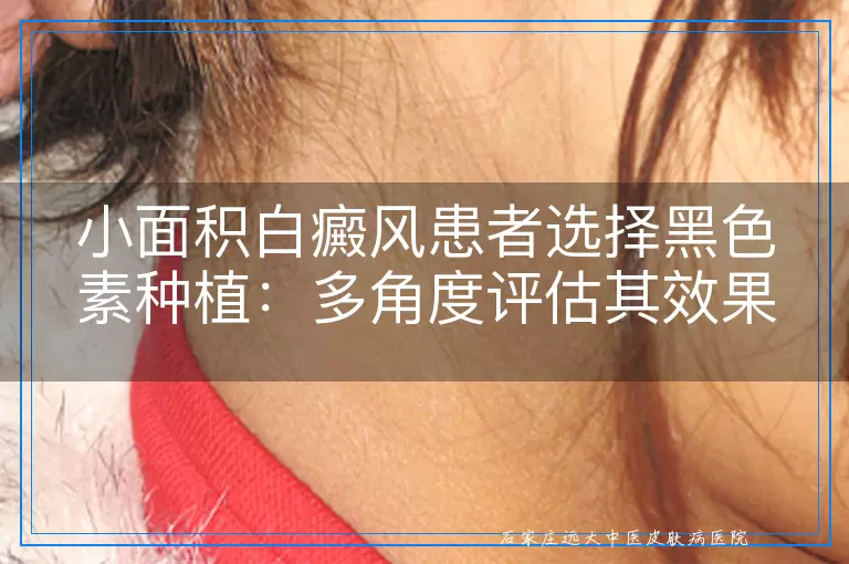 小面积白癜风患者选择黑色素种植：多角度评估其效果与考虑因素