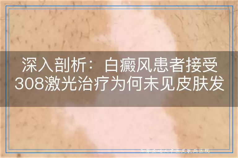 深入剖析：白癜风患者接受308激光治疗为何未见皮肤发红现象