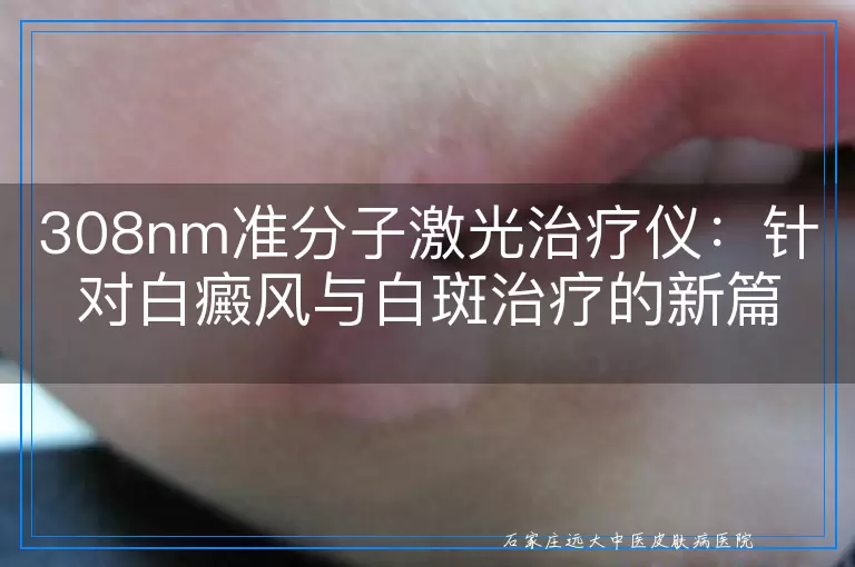 308nm准分子激光治疗仪：针对白癜风与白斑治疗的新篇章