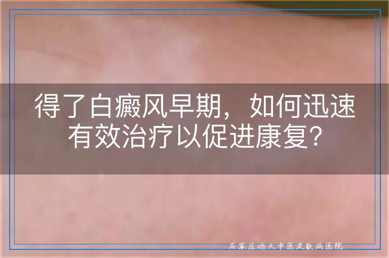 得了白癜风早期，如何迅速有效治疗以促进康复？