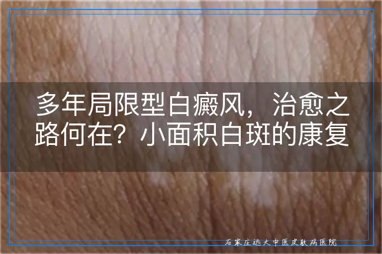 多年局限型白癜风，治愈之路何在？小面积白斑的康复可能性深度剖析