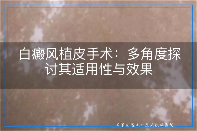 白癜风植皮手术：多角度探讨其适用性与效果