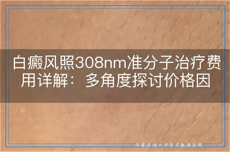 白癜风照308nm准分子治疗费用详解：多角度探讨价格因素