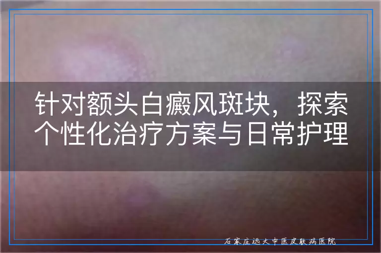 针对额头白癜风斑块，探索个性化治疗方案与日常护理建议