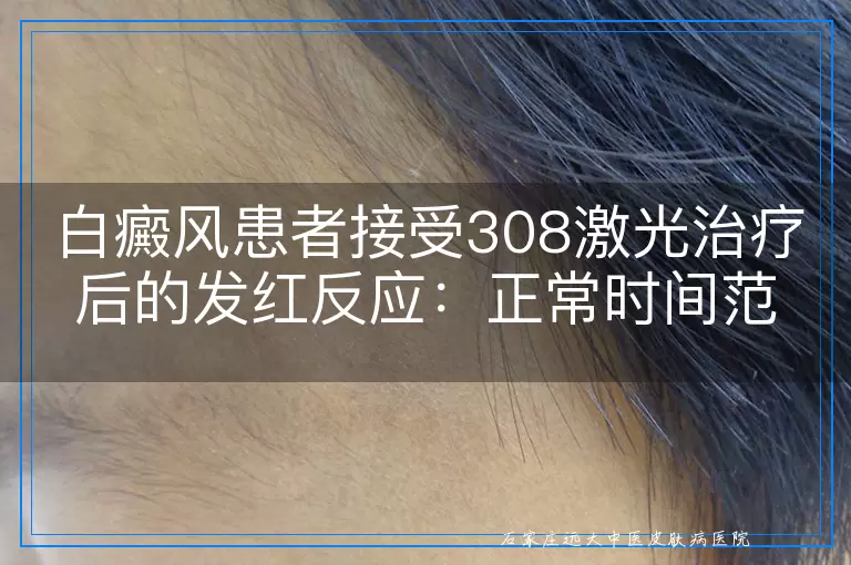 白癜风患者接受308激光治疗后的发红反应：正常时间范围与个体差异解读