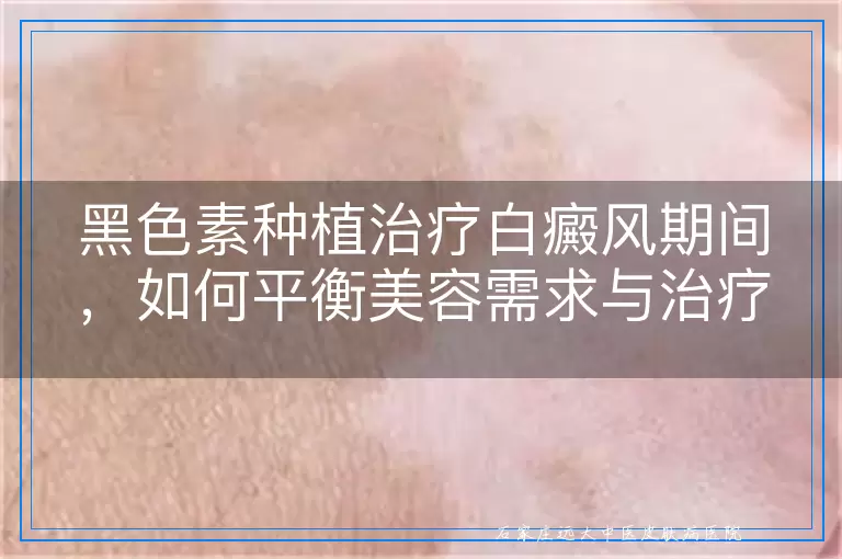 黑色素种植治疗白癜风期间，如何平衡美容需求与治疗效果