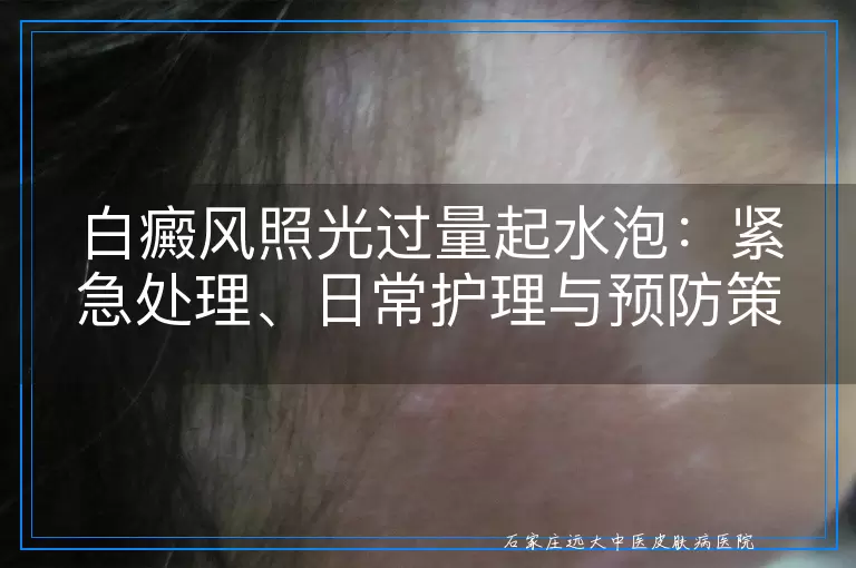 白癜风照光过量起水泡：紧急处理、日常护理与预防策略