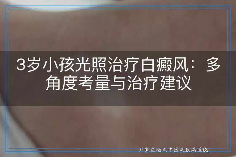 3岁小孩光照治疗白癜风：多角度考量与治疗建议