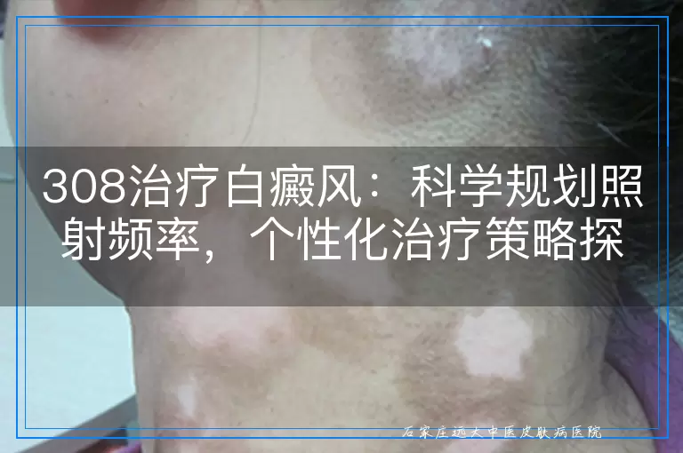 308治疗白癜风：科学规划照射频率，个性化治疗策略探讨
