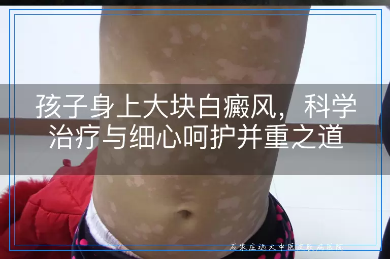 孩子身上大块白癜风，科学治疗与细心呵护并重之道