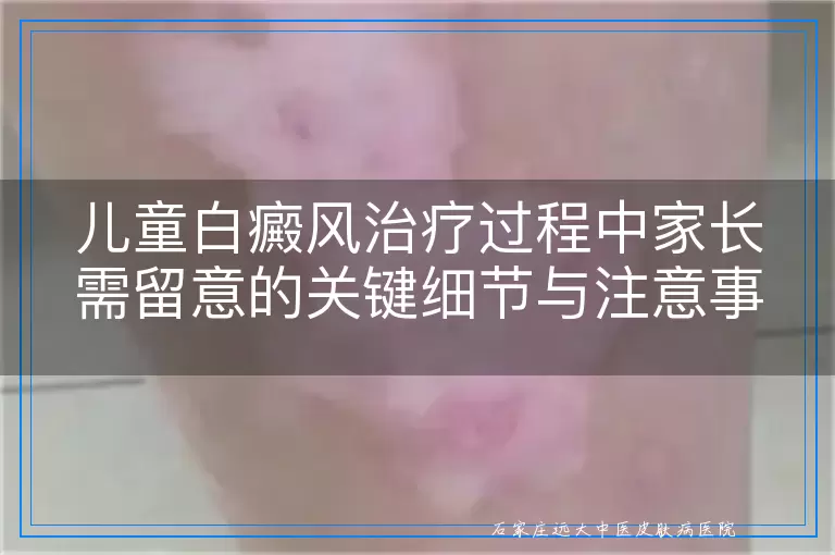 儿童白癜风治疗过程中家长需留意的关键细节与注意事项