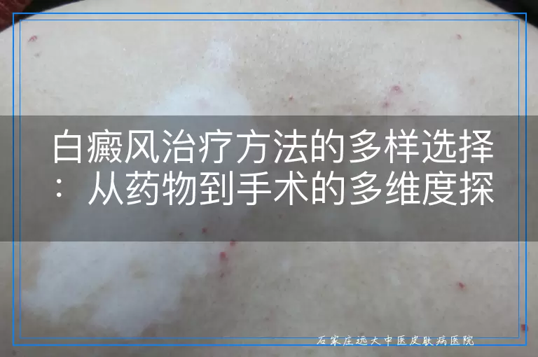白癜风治疗方法的多样选择：从药物到手术的多维度探讨