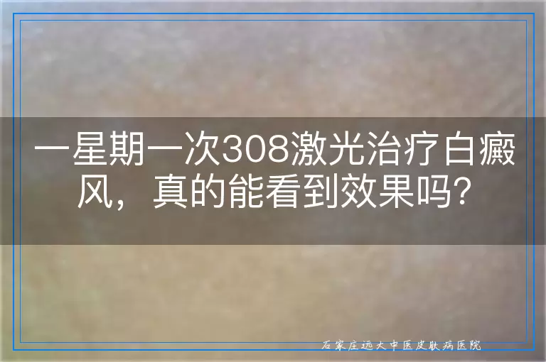 一星期一次308激光治疗白癜风，真的能看到效果吗？