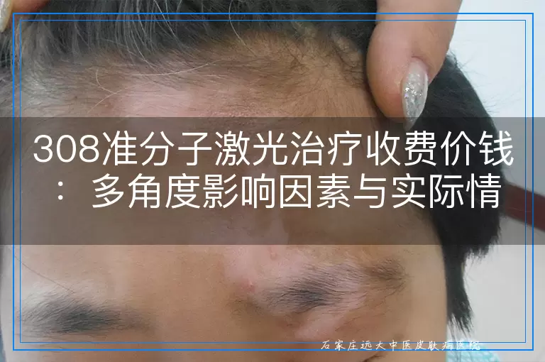 308准分子激光治疗收费价钱：多角度影响因素与实际情况概览