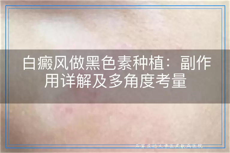 白癜风做黑色素种植：副作用详解及多角度考量
