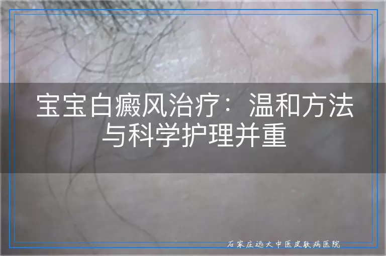 宝宝白癜风治疗：温和方法与科学护理并重