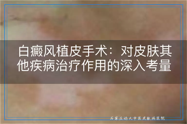 白癜风植皮手术：对皮肤其他疾病治疗作用的深入考量