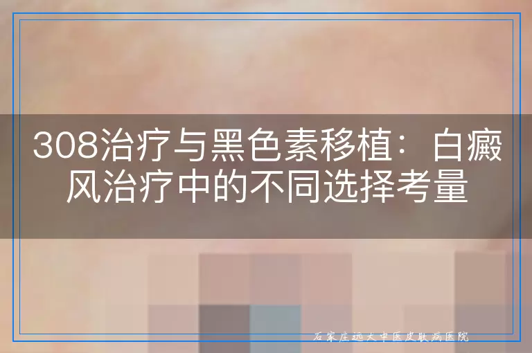 308治疗与黑色素移植：白癜风治疗中的不同选择考量
