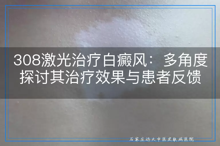 308激光治疗白癜风：多角度探讨其治疗效果与患者反馈