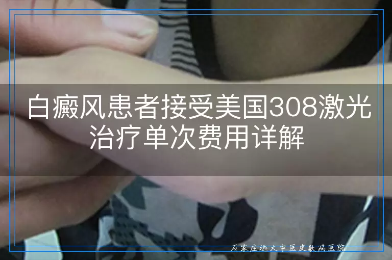白癜风患者接受美国308激光治疗单次费用详解