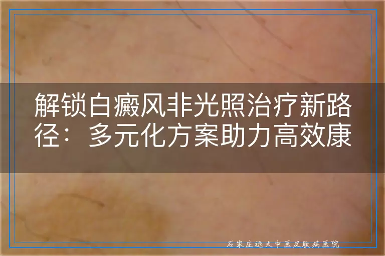 解锁白癜风非光照治疗新路径：多元化方案助力高效康复