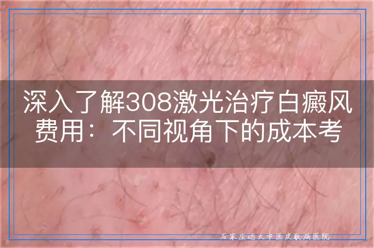 深入了解308激光治疗白癜风费用：不同视角下的成本考量
