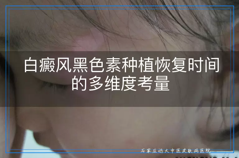 白癜风黑色素种植恢复时间的多维度考量