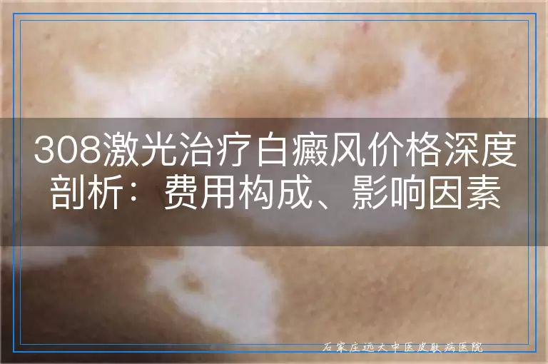 308激光治疗白癜风价格深度剖析：费用构成、影响因素与性价比考量