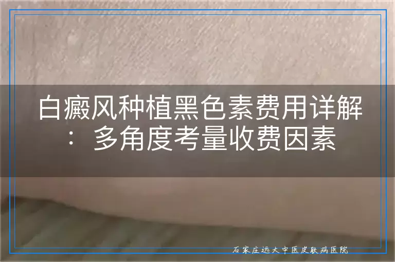 白癜风种植黑色素费用详解：多角度考量收费因素