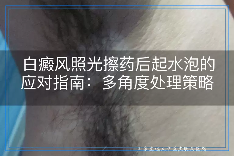 白癜风照光擦药后起水泡的应对指南：多角度处理策略