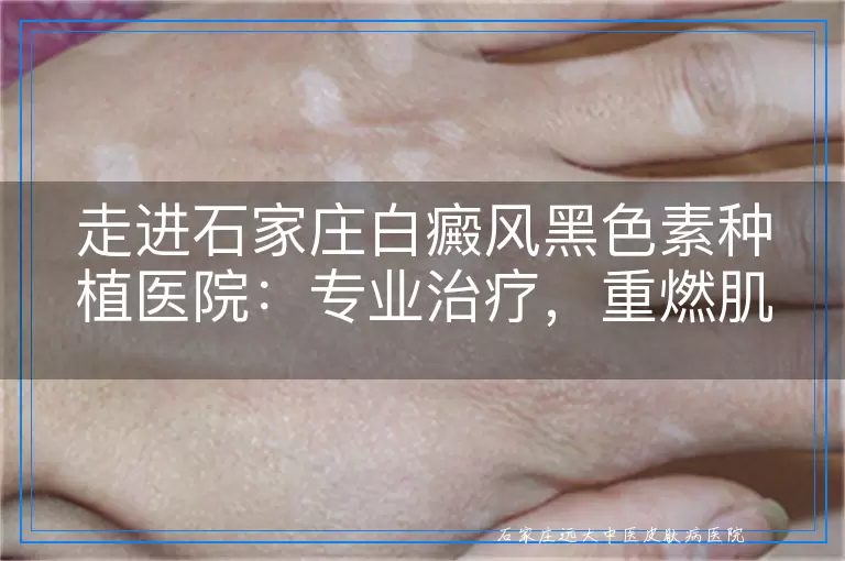 走进石家庄白癜风黑色素种植医院：专业治疗，重燃肌肤希望之光