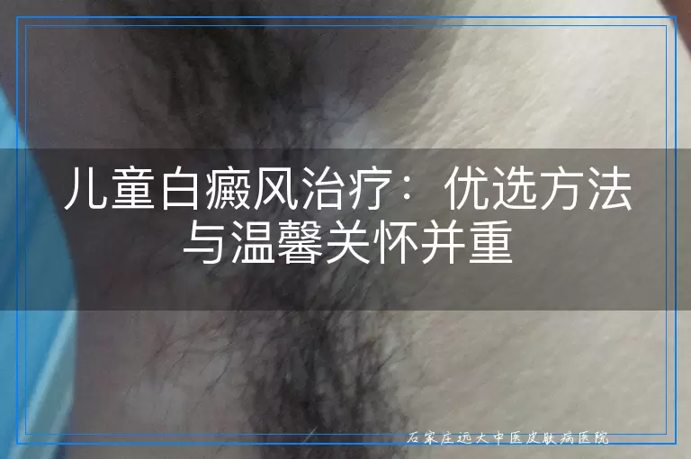 儿童白癜风治疗：优选方法与温馨关怀并重