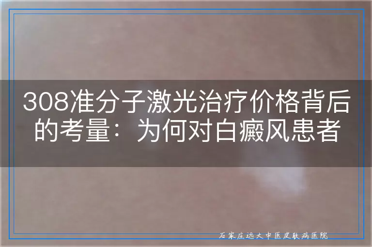 308准分子激光治疗价格背后的考量：为何对白癜风患者而言显得昂贵？