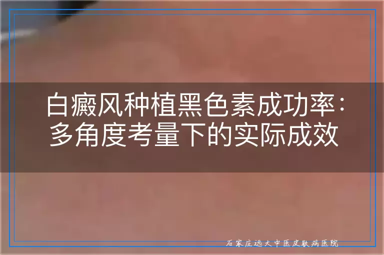 白癜风种植黑色素成功率：多角度考量下的实际成效