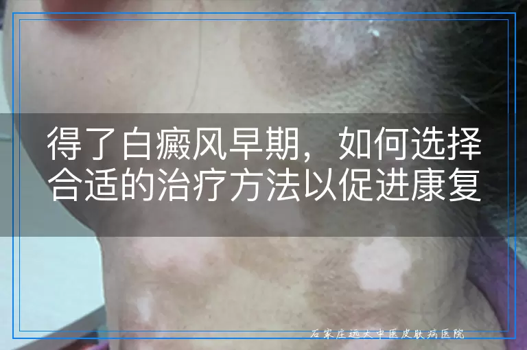 得了白癜风早期，如何选择合适的治疗方法以促进康复