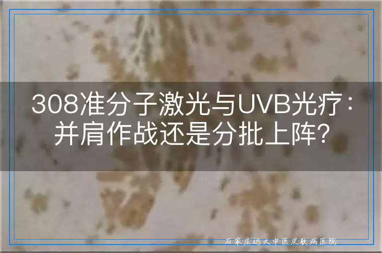 308准分子激光与UVB光疗：并肩作战还是分批上阵？